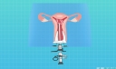 宫腔镜手术是什么手术 什么是宫腔镜手术
