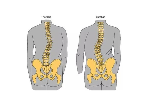 骨盆前倾可以通过正骨恢复吗 骨盆前倾去哪里矫正