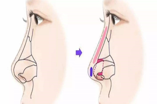 隆鼻可以维持一辈子吗 隆鼻是怎么操作的