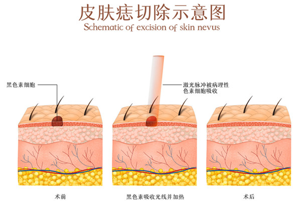 痣6001.jpg