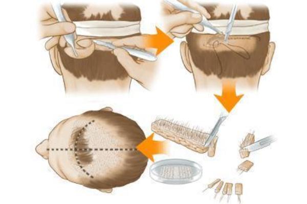 植发是用自己的头发移植吗 植发的危害和后遗症